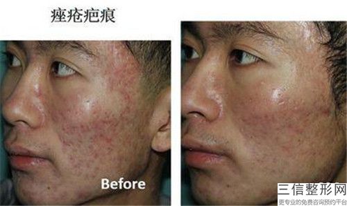 张敏靶向祛疤术术后护理要注意哪些