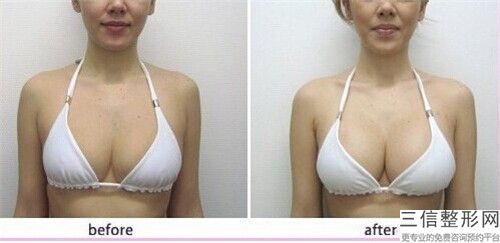 襄阳悦美整形男性乳房全切手术一般会出现哪些后遗症