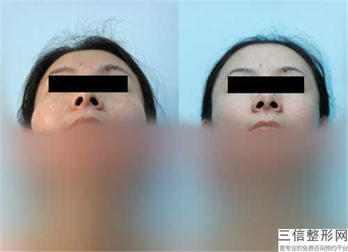 北京碧莲盛无痕植发开颌不矫正后效果维持几年