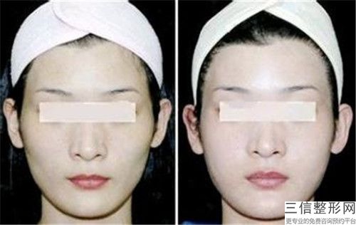 上饶九九医院整形科男性面脂肪填充术能保持多久，好不好