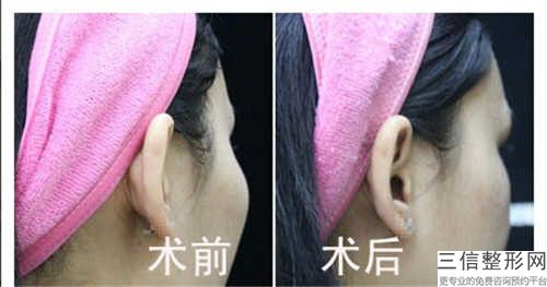台州上颌窦筛窦开放术费用取决于哪些因素