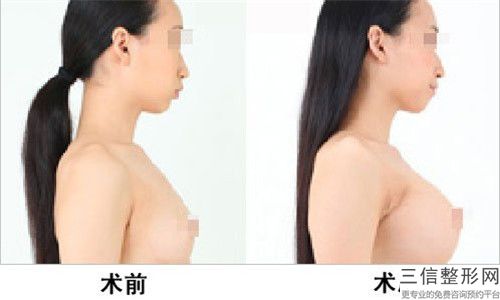 无锡市哪医院做假体隆胸超声刀哪家实力棒(南京医科大学友谊整形外科无锡分院人气医生PK)