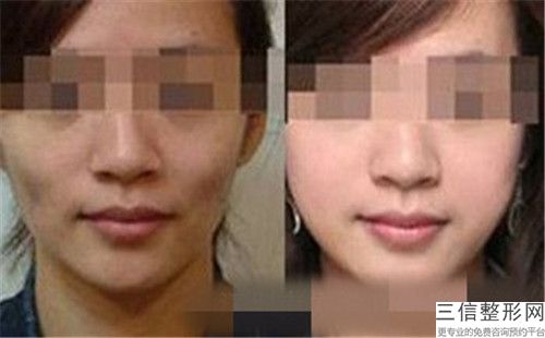 常州脸上疤痕修复修复整形效果怎么样