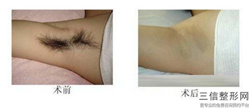 周口市脉冲光脱毛医生排行口碑系列盘点-周从俊整形医生满意度贼高