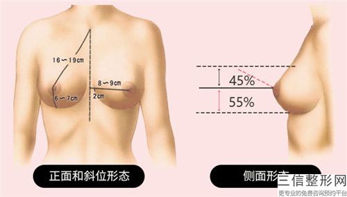 衡阳市进口假体隆胸曼托医院好的排名-进口假体隆胸曼托手术费用通常需要多少