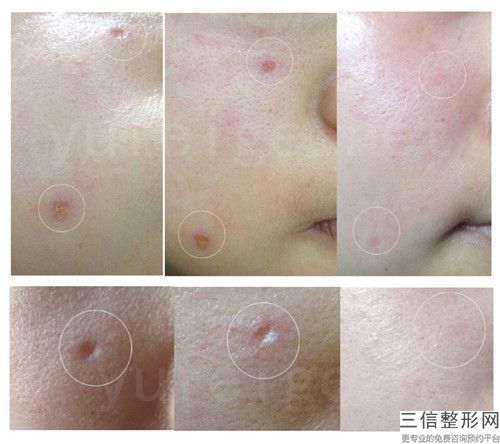 东营市快速清除晒斑医生排行榜前十明细更新-王学红医生很不错哦