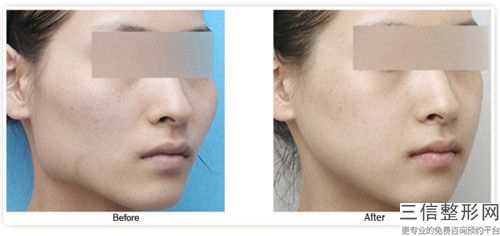 重庆杨海波口腔门诊部矫正牙齿上颌的方式及术后护理