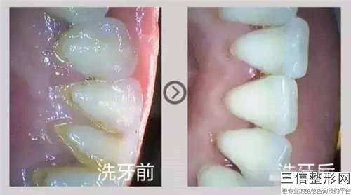 广州伟联口腔诊所韩国登腾种植牙术的作用如何能维持多久