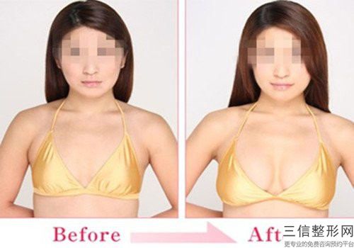 烟台市隆胸取出手术整形美容医院(烟台洛神医学美容医院广受网友好评_)