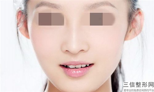 周口市鼻综合假体医生哪里好(李宜桦医生从效果图看医生技术)