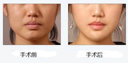 下颌角整形多少钱_下颌角整形整形手术价格