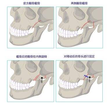 颧骨内推多少钱_颧骨内推整形手术价格