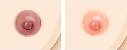 乳晕漂红多少钱_乳晕漂红整形手术价格