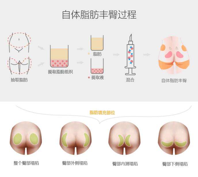 自体脂肪丰臀多少钱_自体脂肪丰臀整形手术价格
