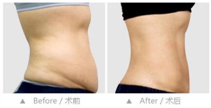 腹壁成形术多少钱_腹壁成形术整形手术价格