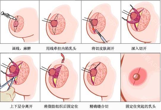乳晕缩小多少钱_乳晕缩小整形手术价格