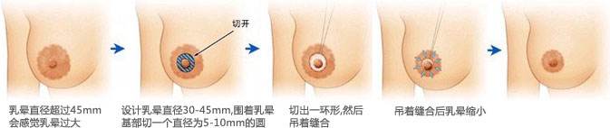 乳晕缩小多少钱_乳晕缩小整形手术价格