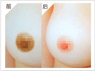 乳晕缩小多少钱_乳晕缩小整形手术价格