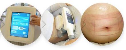 冷冻溶脂瘦腹部多少钱_冷冻溶脂瘦腹部整形手术价格