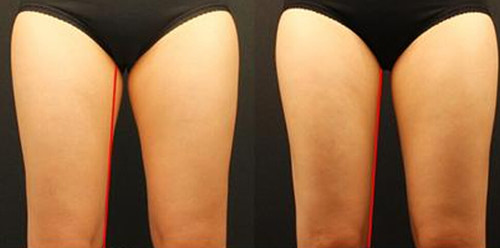 冷冻溶脂瘦大腿多少钱_冷冻溶脂瘦大腿整形手术价格