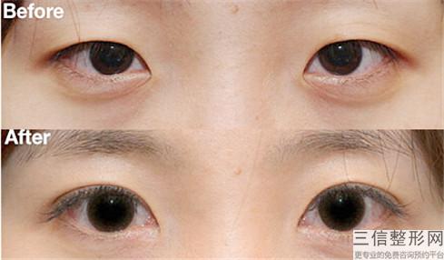 双眼皮手术过后需注意些什么呢