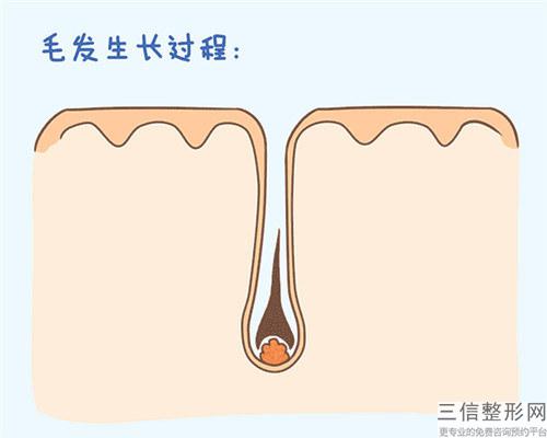 opt激光脱毛后整个身体毛囊会造成阻塞吗