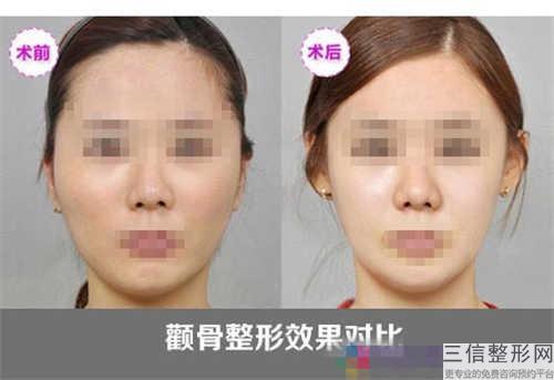 下颌角切除术收费大概是多少钱
