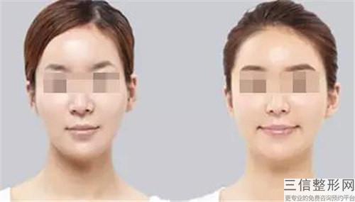 现在受欢迎的激光除去颈纹所需费用预估在好多左右